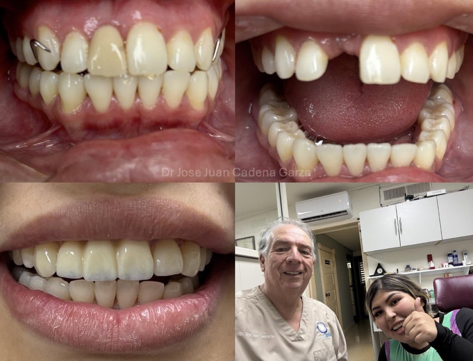 Caso antes y después de estética dental