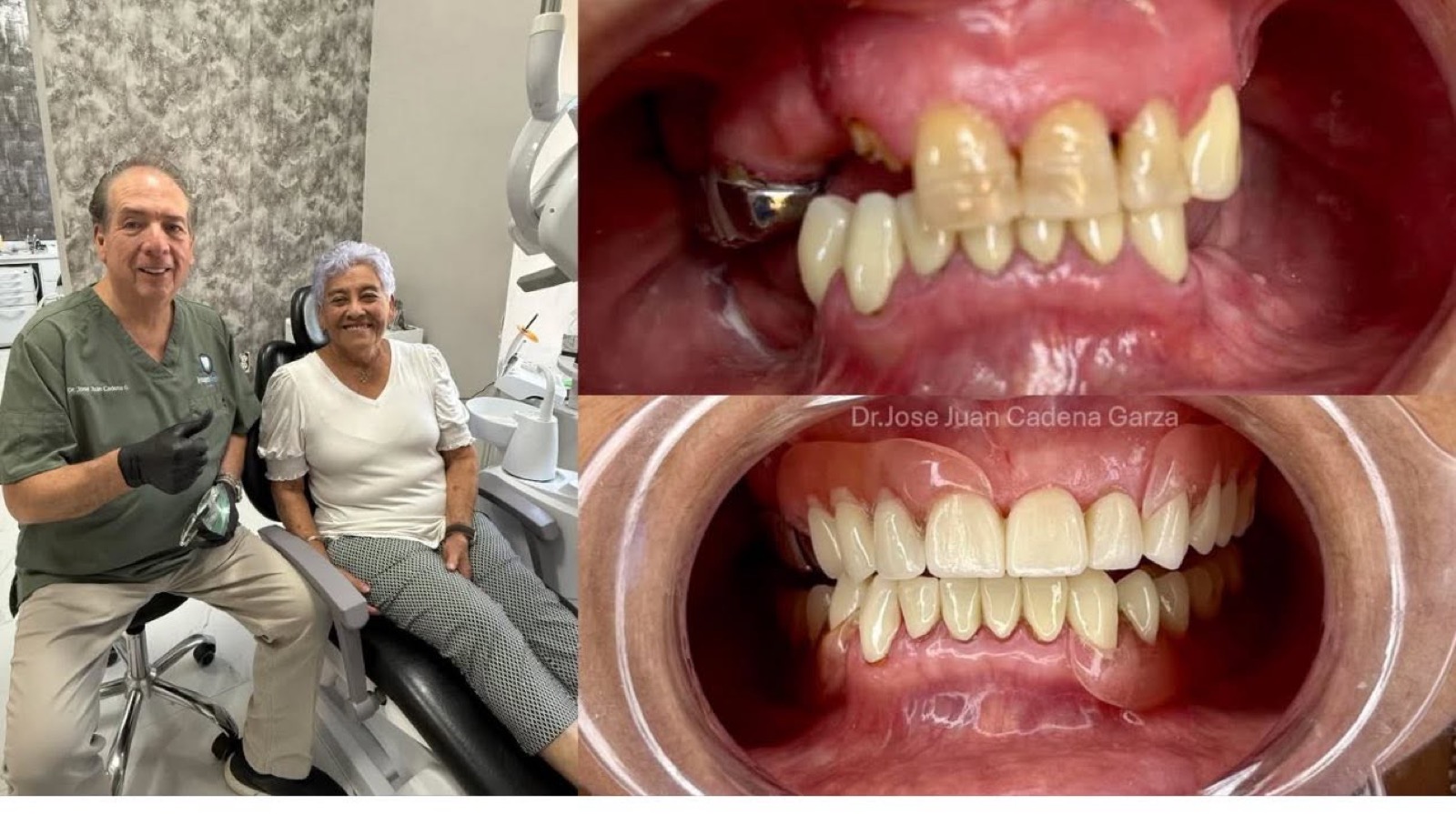 Caso antes y después de rehabilitación dental
